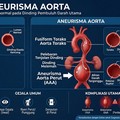Intai Nyawa, Ini Bahaya Gangguan pada Aorta Jantung