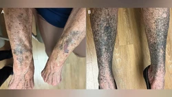 Awal Mula Kulit Wanita 68 Tahun Jadi Hitam usai Minum Antibiotik untuk Jerawat