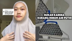 Viral Wanita Bekasi Disebut Dokter Punya Wajah Khas Gagal Ginjal, Apa Ciri-cirinya?