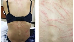 Makan Jamur Shiitake, Punggung Wanita Ini Dipenuhi Ruam Mirip Bekas Cambukan