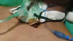 Leher Warga Jembrana Terjerat Kabel WiFi hingga Pita Suara Robek