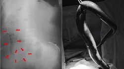 Dokter Sampai Syok! Belut 65 Cm Ditemukan Masih Hidup di Usus Pria Ini