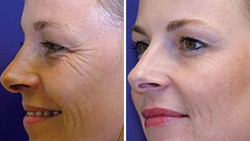 Viral! Foto Beda Wajah Kembar Identik: 20 Tahun Pakai Botox Vs Tidak
