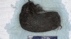 Kronologi Dokter Temukan 1,5 Kg Gumpalan Rambut di Perut Gadis 16 Tahun