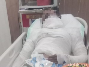 Sopir Truk Asal Karangasem yang Dibakar Bosnya Meninggal Dunia