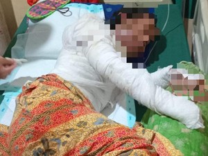 Suami di Lampung Bakar Istri yang Lagi Hamil, Korban Luka Bakar 80%